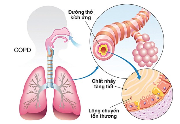 Bệnh phổi tắc nghẽn mạn tính – Cách nhận biết sớm